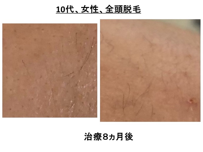 円形脱毛症　病院